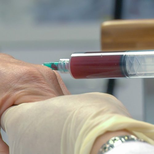PRP TERAPIJA: VLASTITOM KRVLJU PROTIV BOLOVA U ZGLOBOVIMA