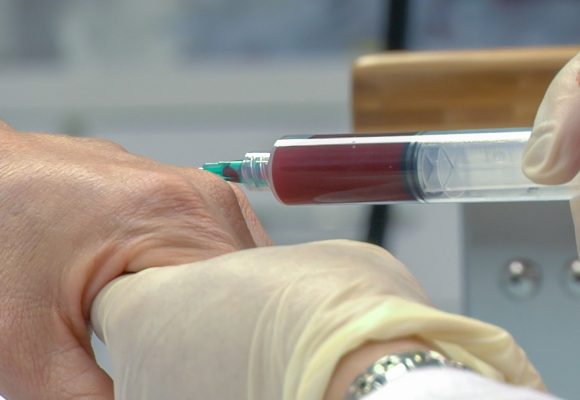 PRP TERAPIJA: VLASTITOM KRVLJU PROTIV BOLOVA U ZGLOBOVIMA