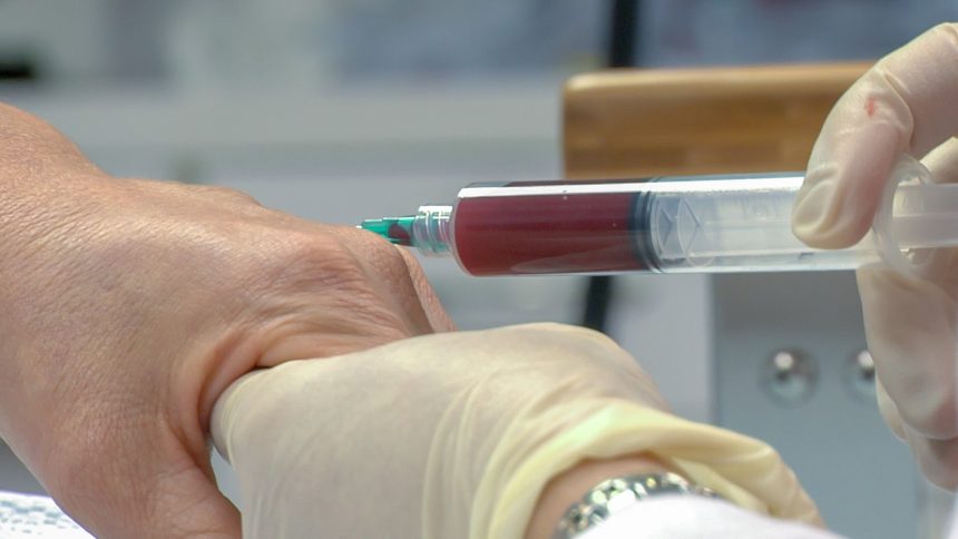 PRP TERAPIJA: VLASTITOM KRVLJU PROTIV BOLOVA U ZGLOBOVIMA